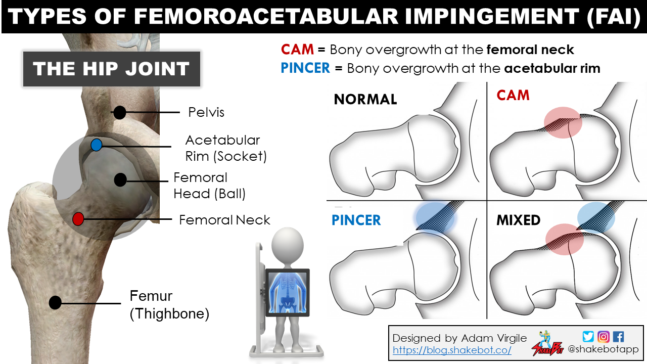 Read more about the article The Hip in Ice Hockey Part 6: How to Treat Hip Pain and The Impact of Early Sport Specialization on Femoroacetabular Impingement in Young Athletes